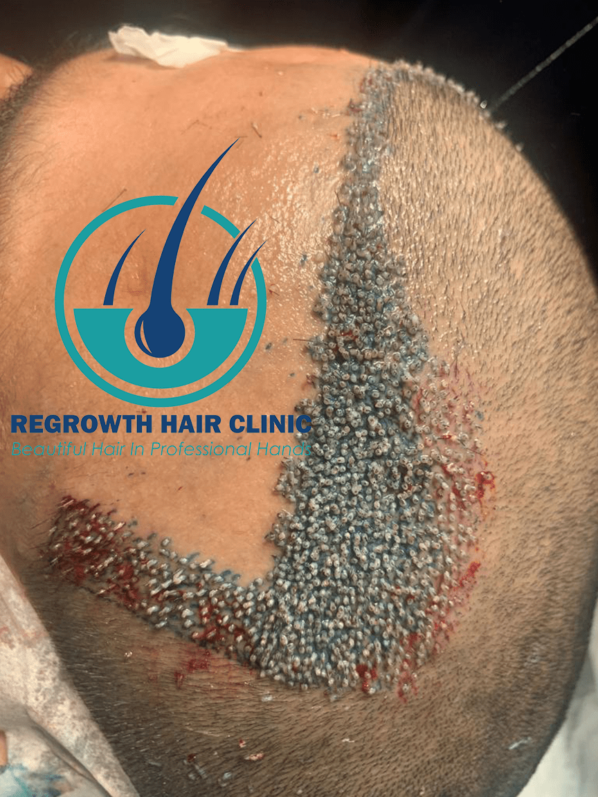 Regrowth Hair Clinic In Raipur 10