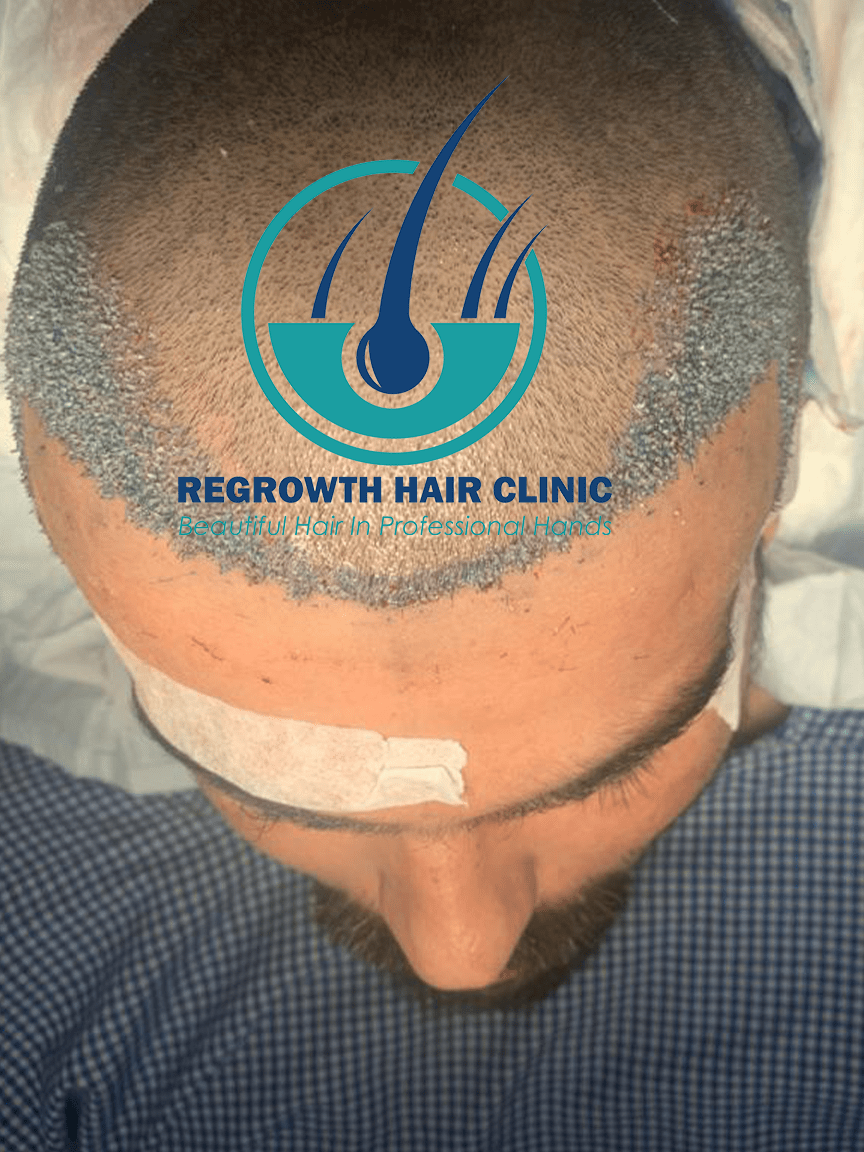 Regrowth Hair Clinic In Raipur 11