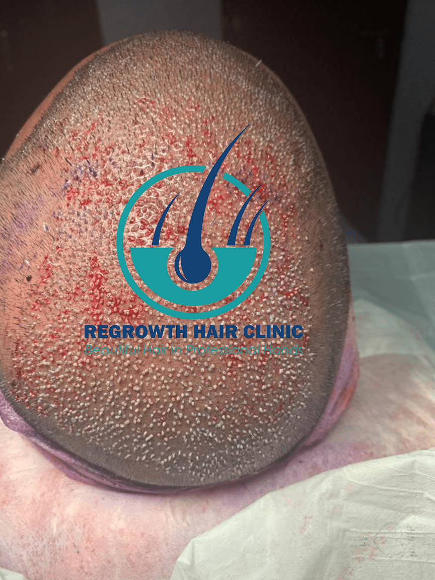 Regrowth Hair Clinic In Raipur 12