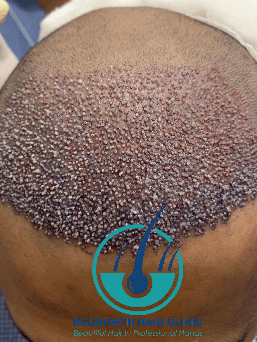 Regrowth Hair Clinic In Raipur 14