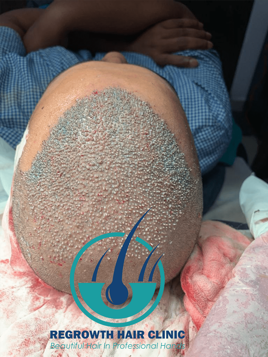 Regrowth Hair Clinic In Raipur 15