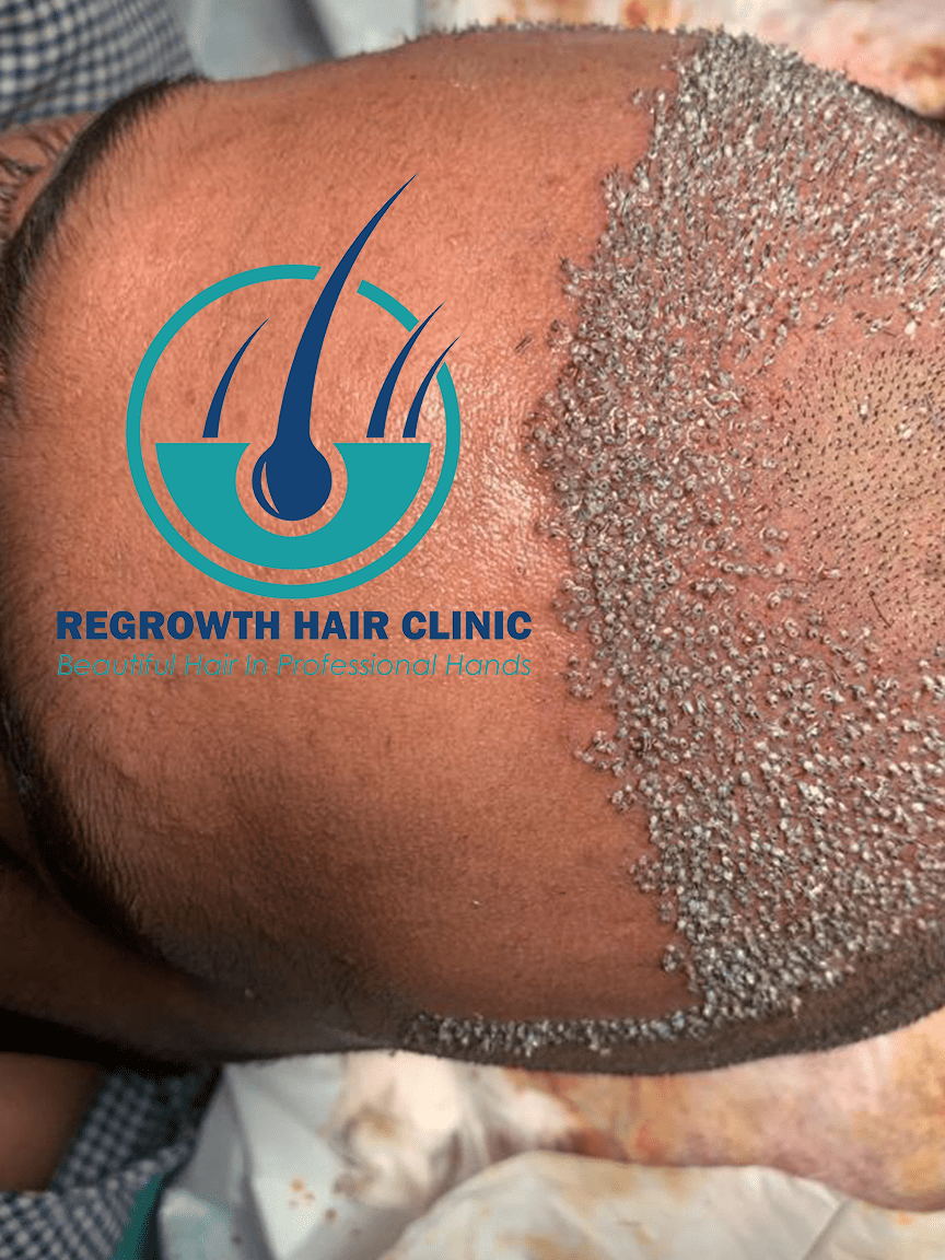 Regrowth Hair Clinic In Raipur 18