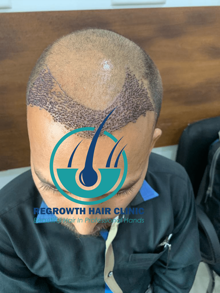 Regrowth Hair Clinic In Raipur 2