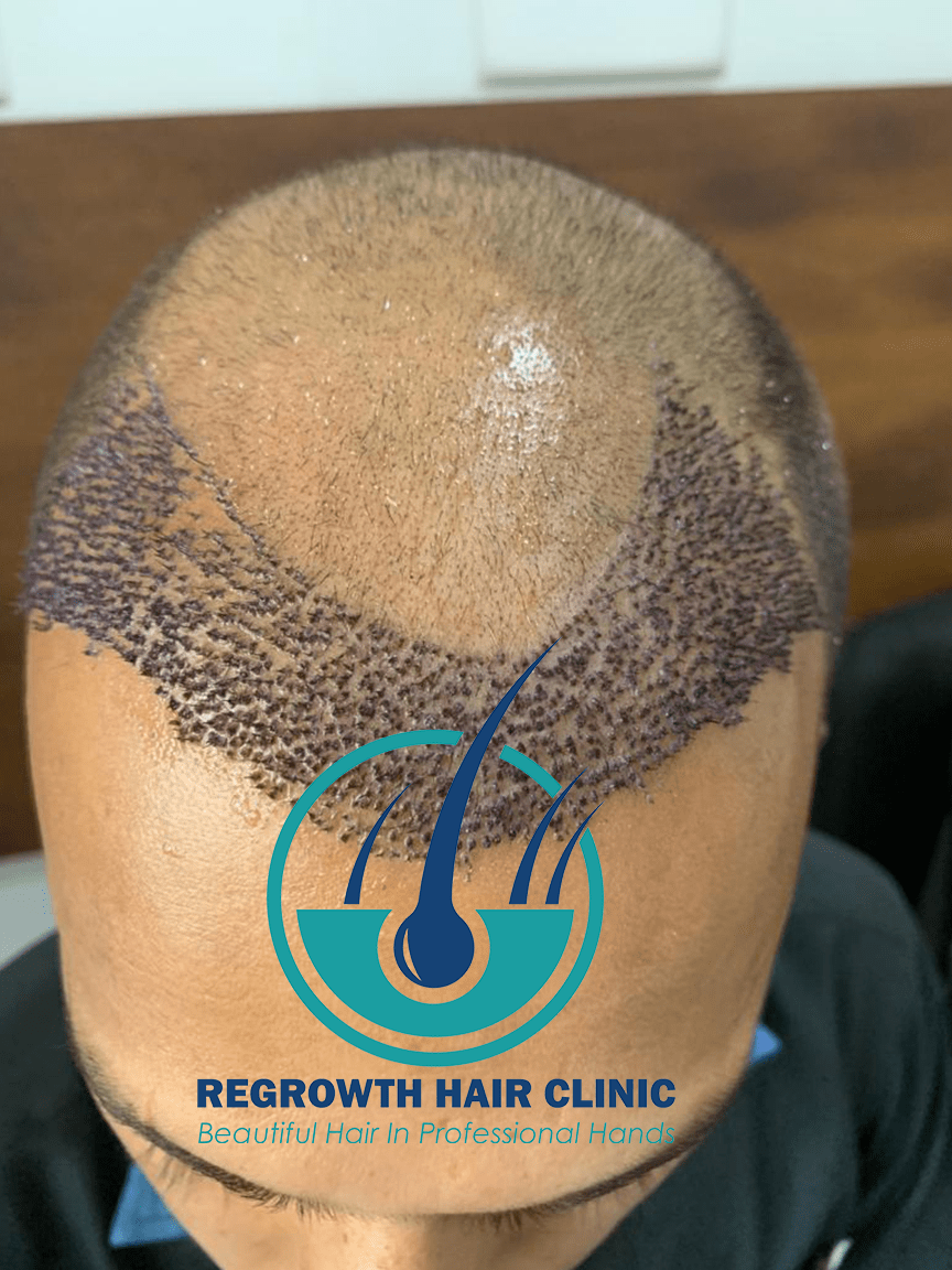 Regrowth Hair Clinic In Raipur 3