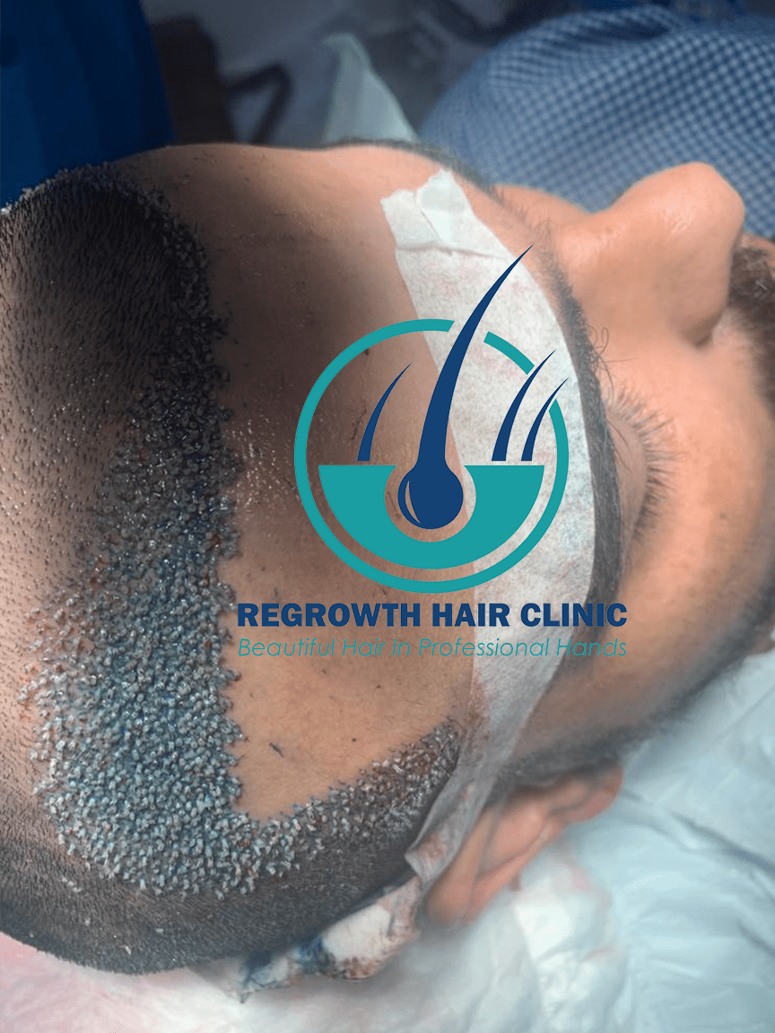 Regrowth Hair Clinic In Raipur 6