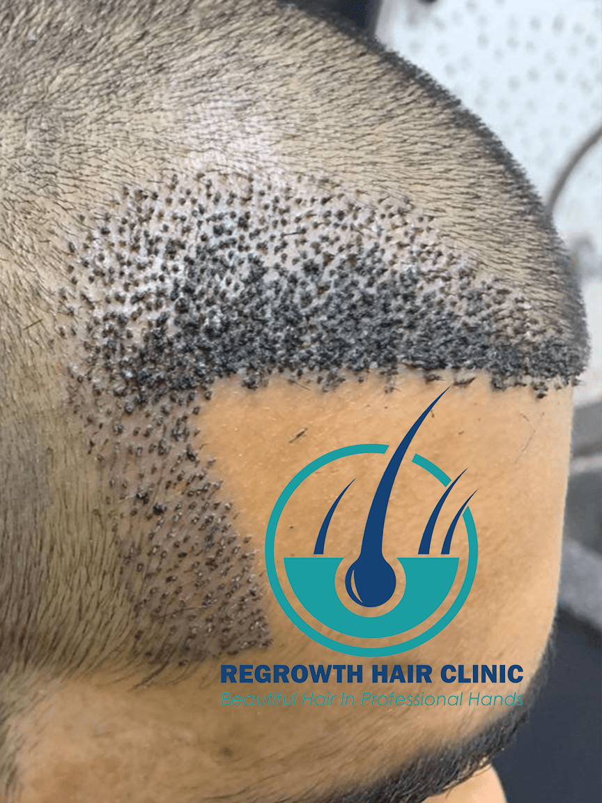 Regrowth Hair Clinic In Raipur 9