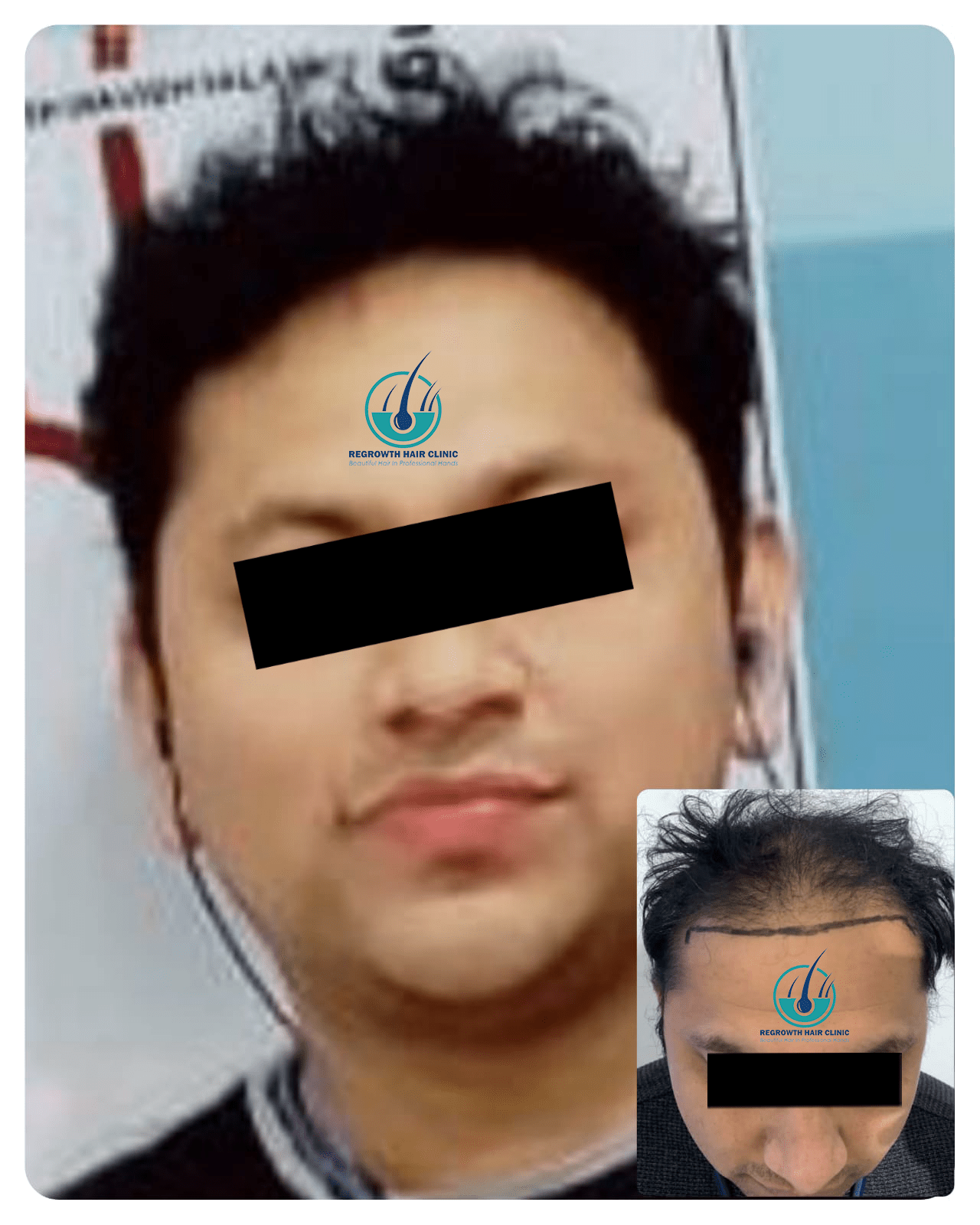 Regrowth Hair Clinic Raipur CG 4