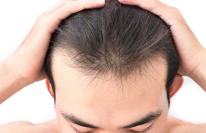 Hair PRP Treatment In Raipur