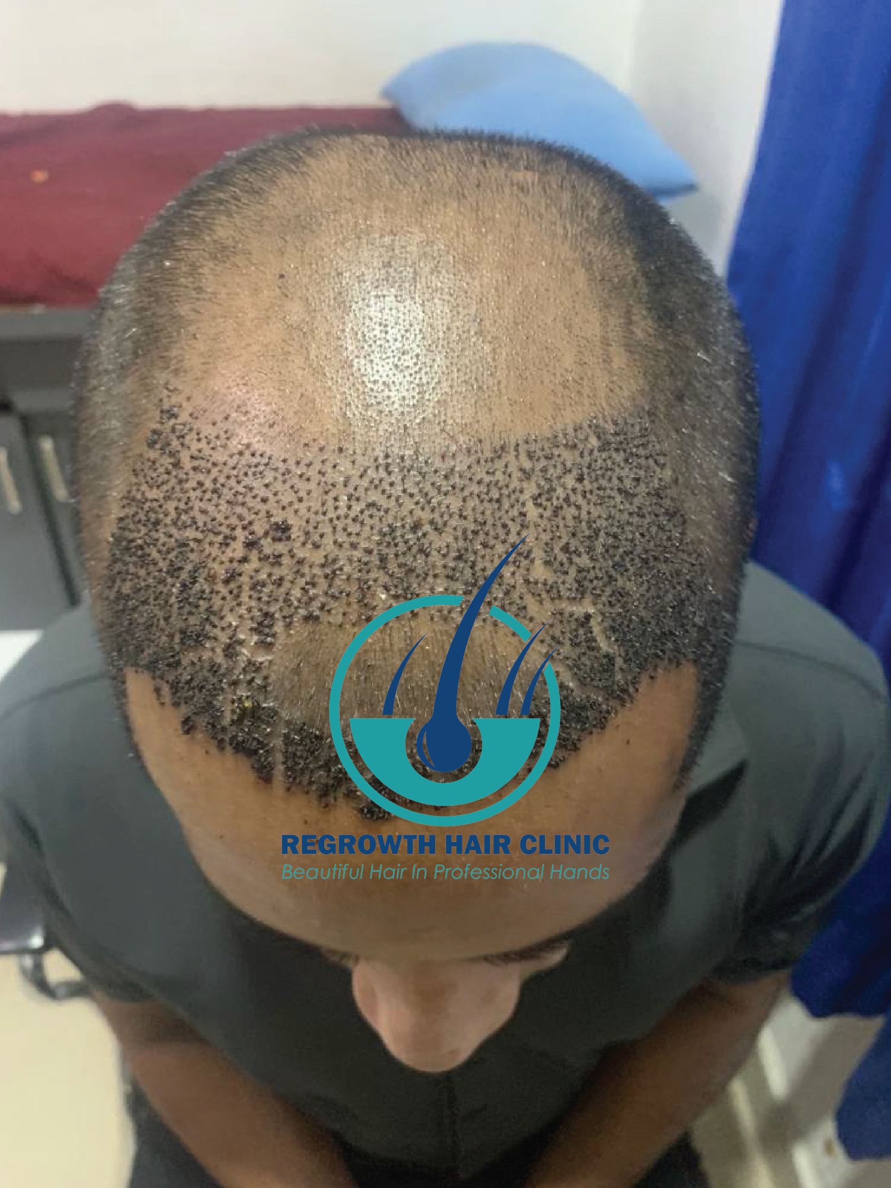 Regrowth Hair Clinic In Raipur 21-01